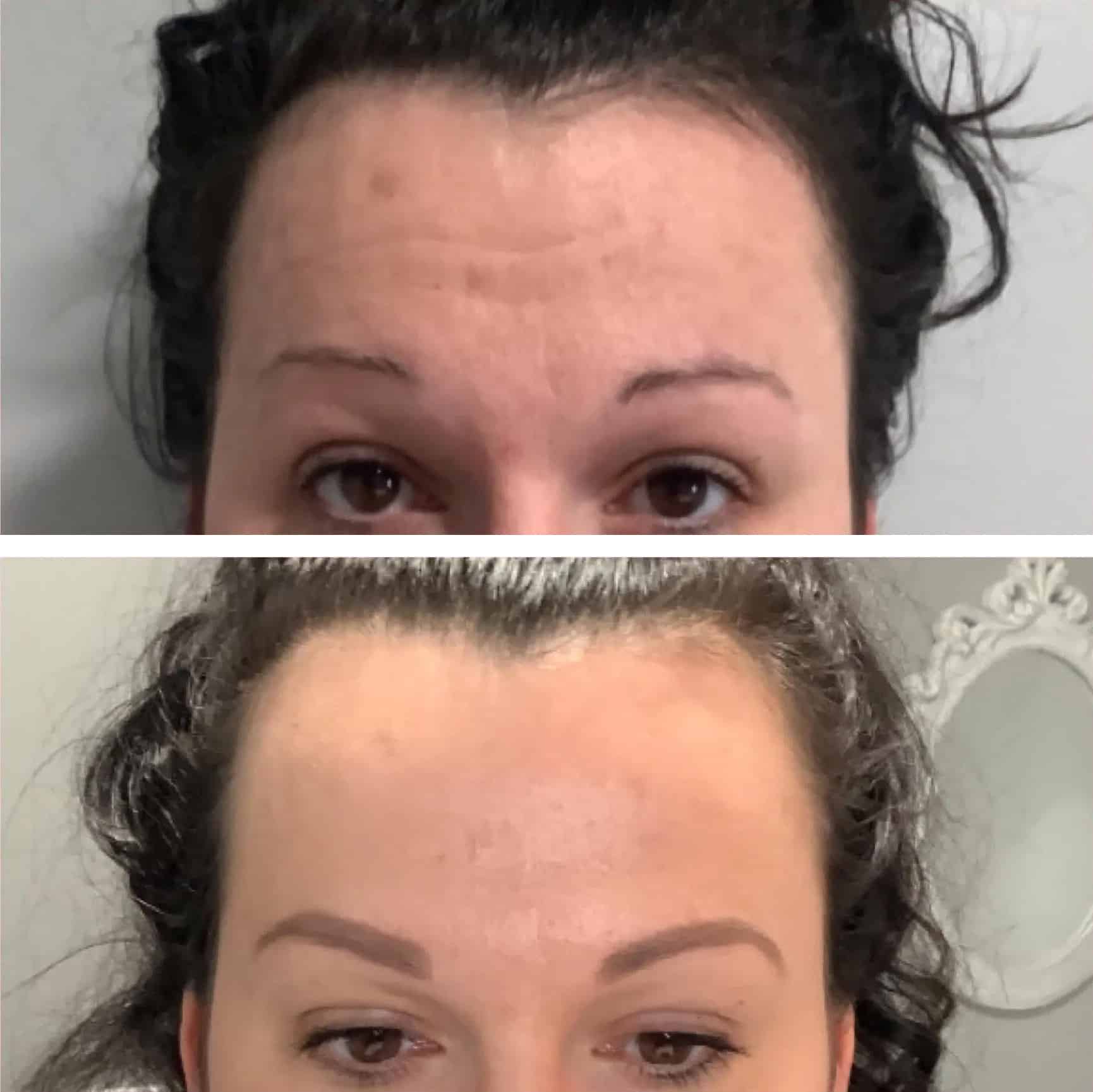 Botox and Dysport 2 Before & After from Lolia Aesthetics in Georgetown, KY