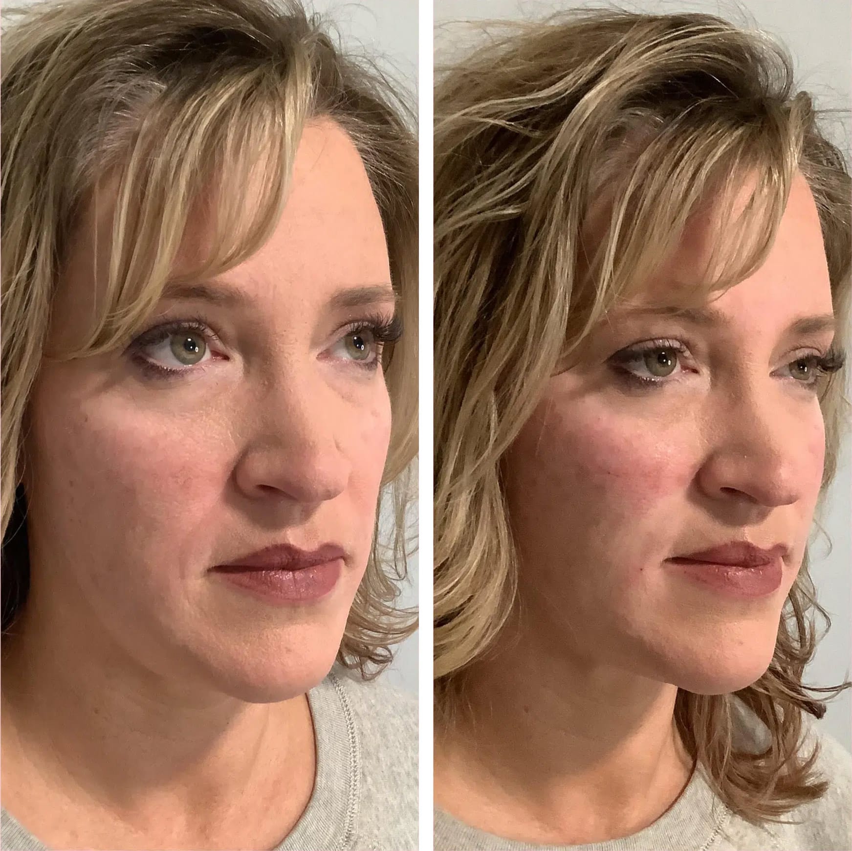 Cheek and Midface Before & After from Lolia Aesthetics in Georgetown, KY
