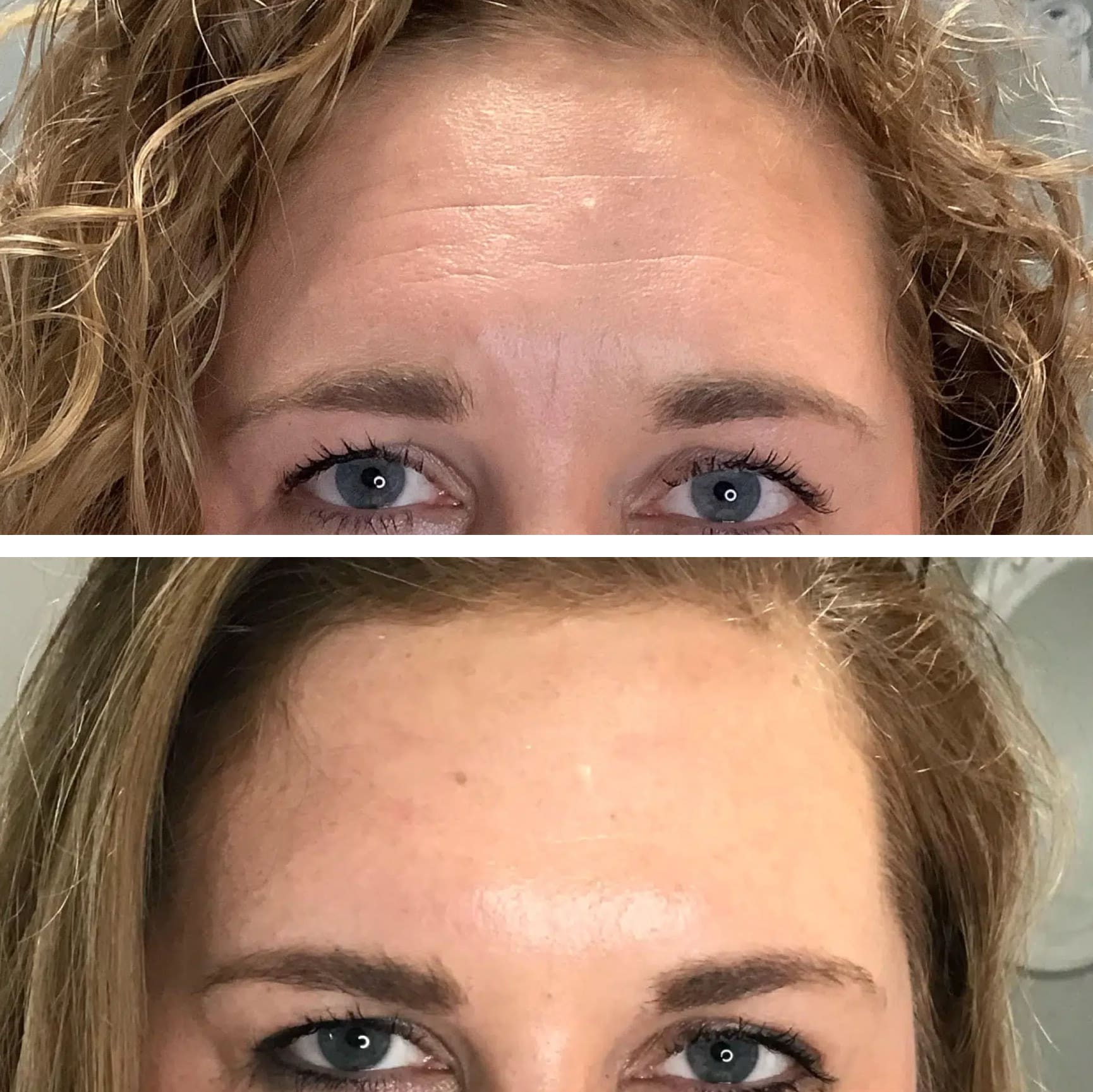 Botox and Dysport 3 Before & After from Lolia Aesthetics in Georgetown, KY