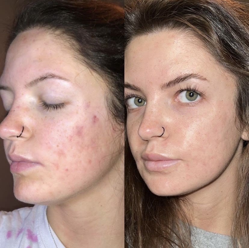 Opus Plasma Skin Resurfacing Before & After from Lolia Aesthetics Georgetown, KY